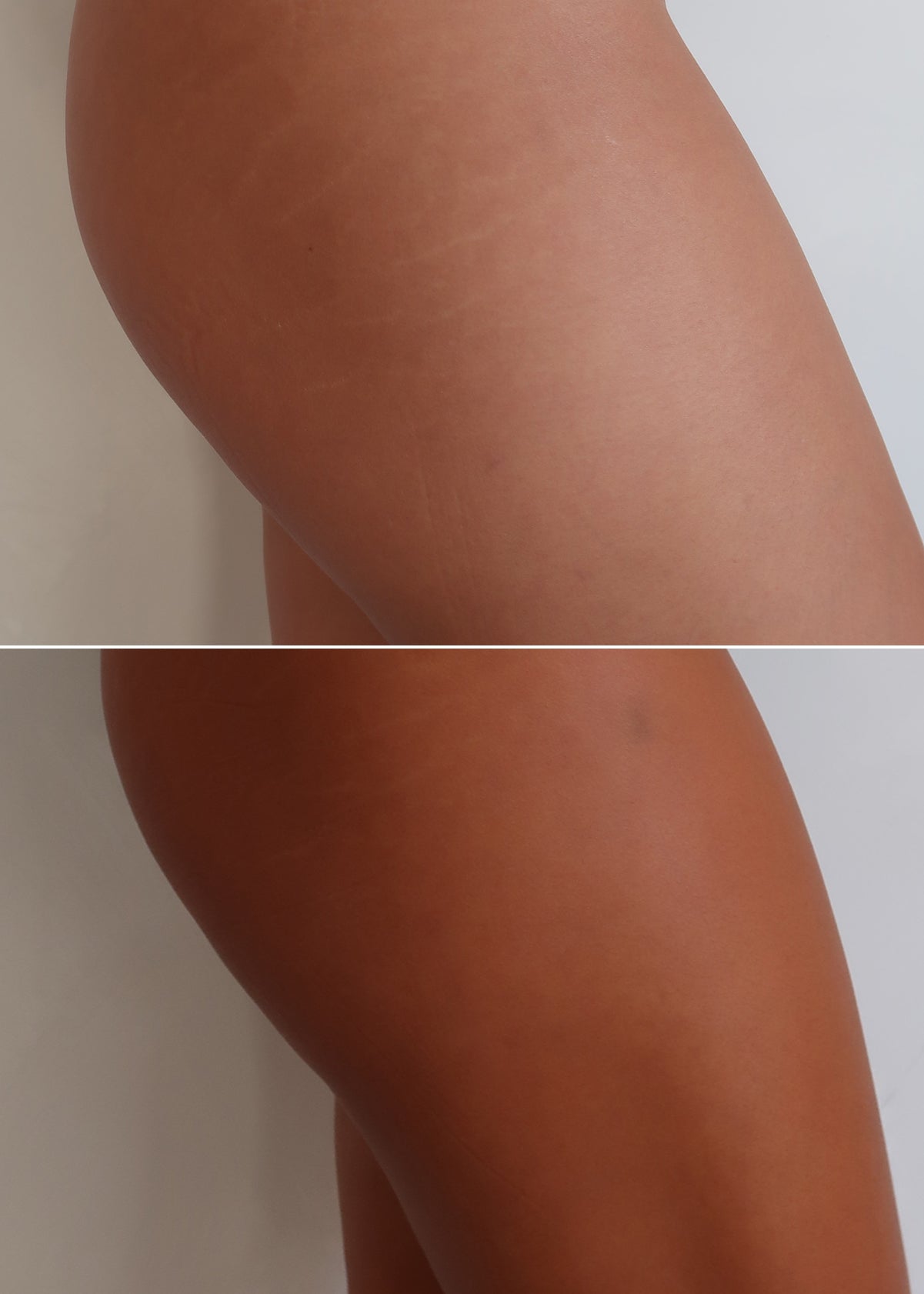 Thigh close-ups showing faint stretch marks in top panel and smoother skin in bottom panel, separated by white divider.